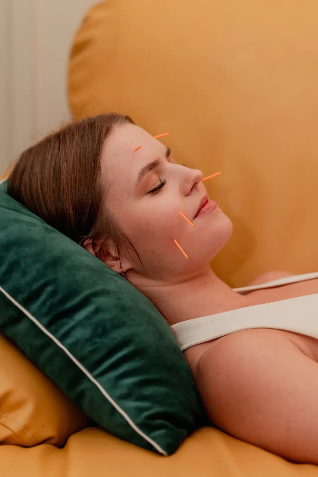 Fine acupuncture needles placed during a wellness therapy session